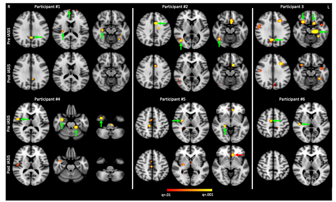 Treatment Study: IASIS reduced abnormal slow waves in 6 mTBI patients